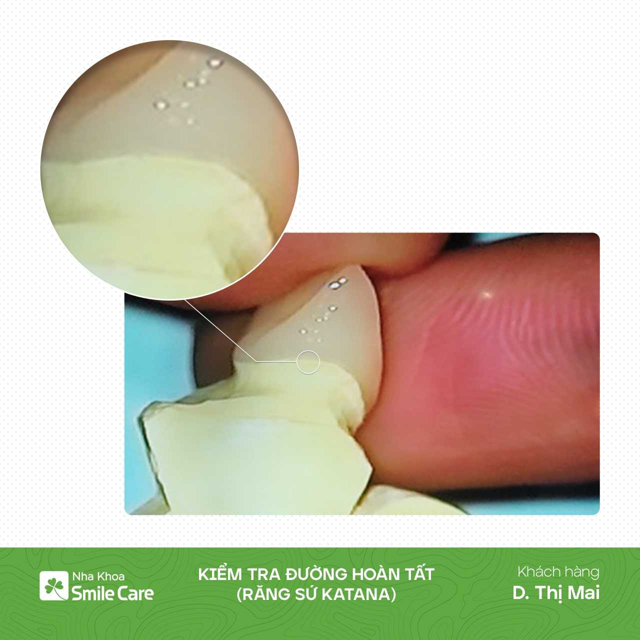 Kiểm tra đường hoàn tất 16 răng sứ Katana - D. Thị Mai