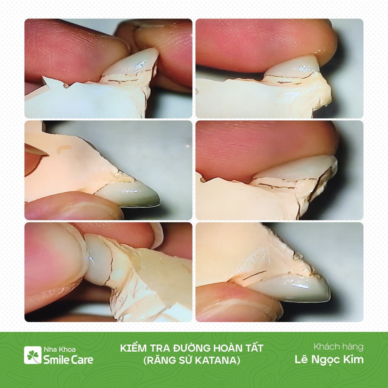 Kiểm tra đường hoàn tất 16 răng sứ Katana