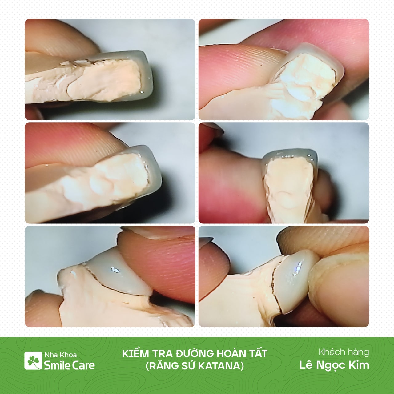 Kiểm tra đường hoàn tất 16 răng sứ Katana