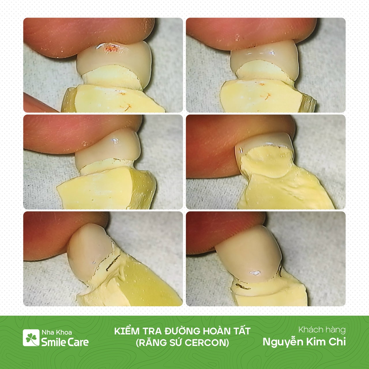 Kiểm tra đường hoàn tất 08 răng sứ Cercon