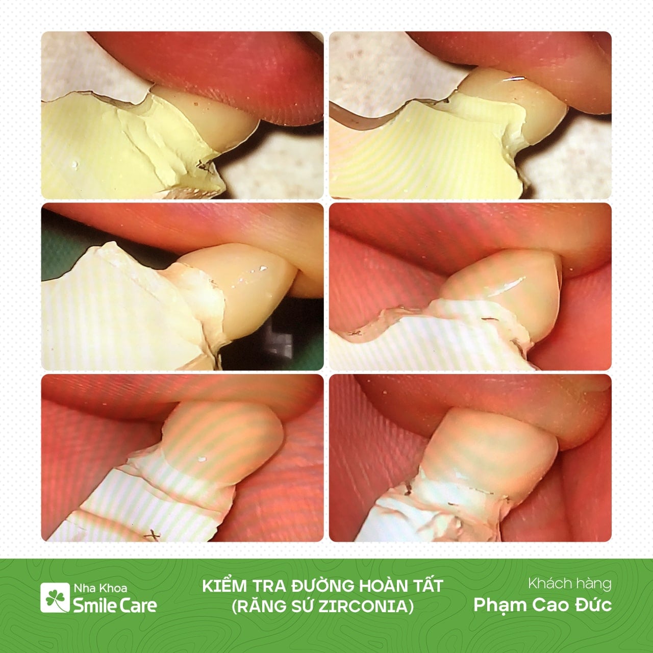 Kiểm tra đường hoàn tất 08 răng sứ Zirconia