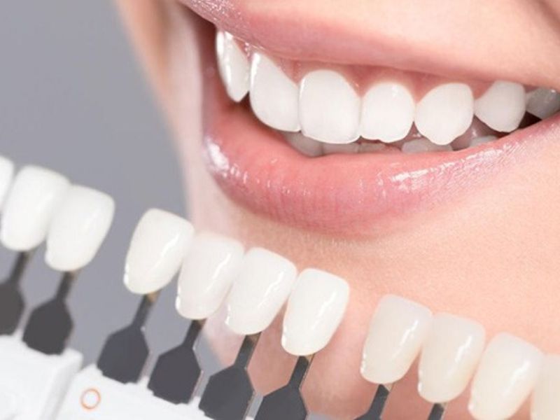 dán sứ thẩm mỹ