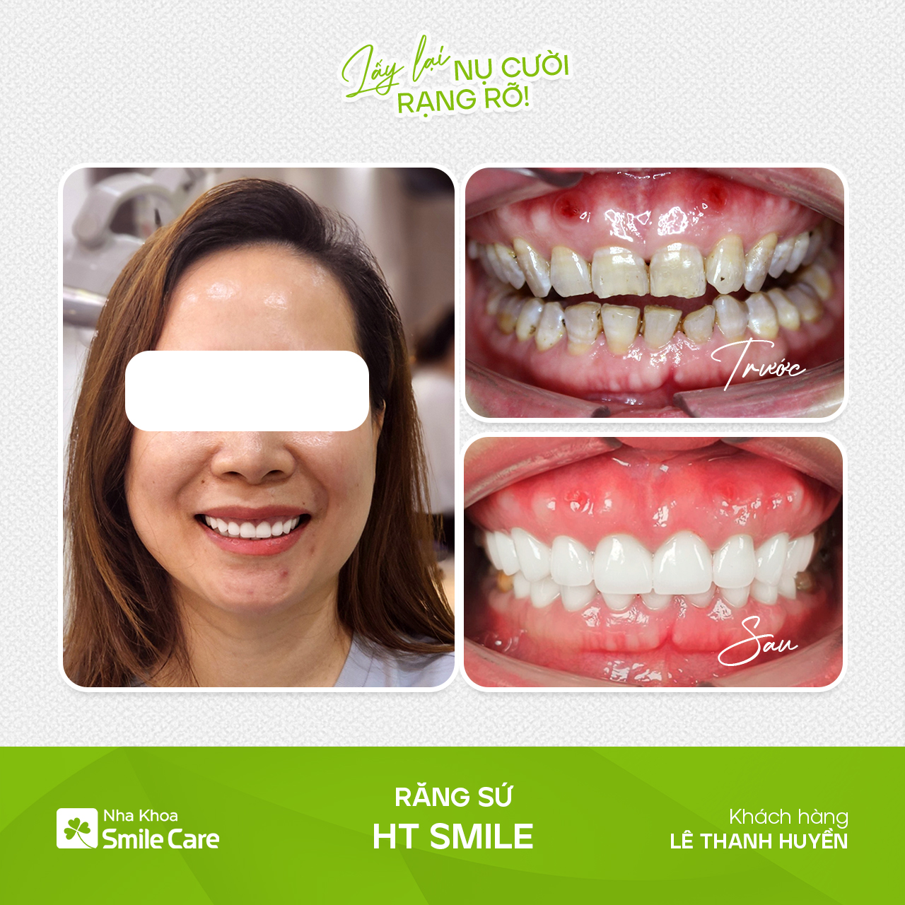 Răng sứ Lê Thanh Huyền