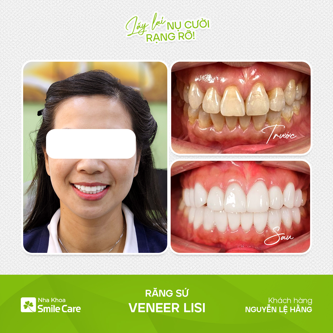 Răng sứ Nguyễn Lệ Hằng